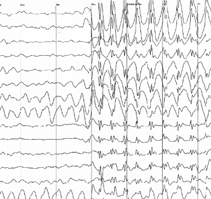 EEG Wikipedia Commons.