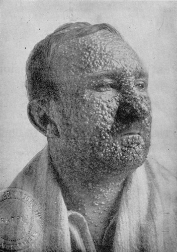 The ravages of smallpox. via Wikipedia Commons