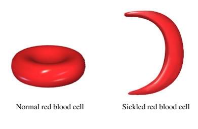 Sickle cell via Wikipedia Commons